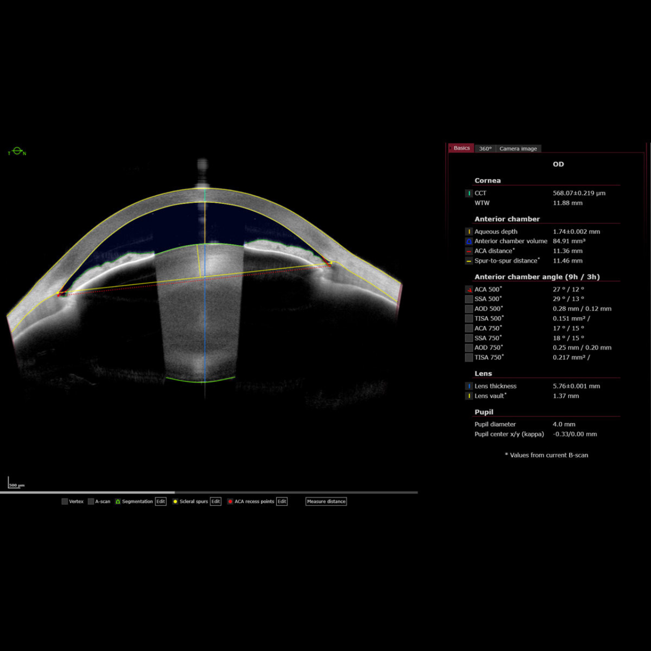 Heidelberg Anterion Metrics App INNOVA