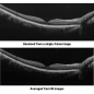 Optical Coherence Tomography / Fundus Camera
Retina Scan Duo™2 Denoising using deep learning