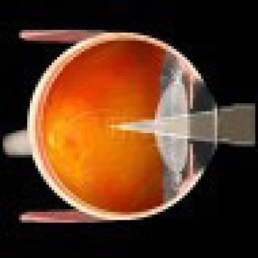 Volk Singh Mid-Vitreous Laser Lens